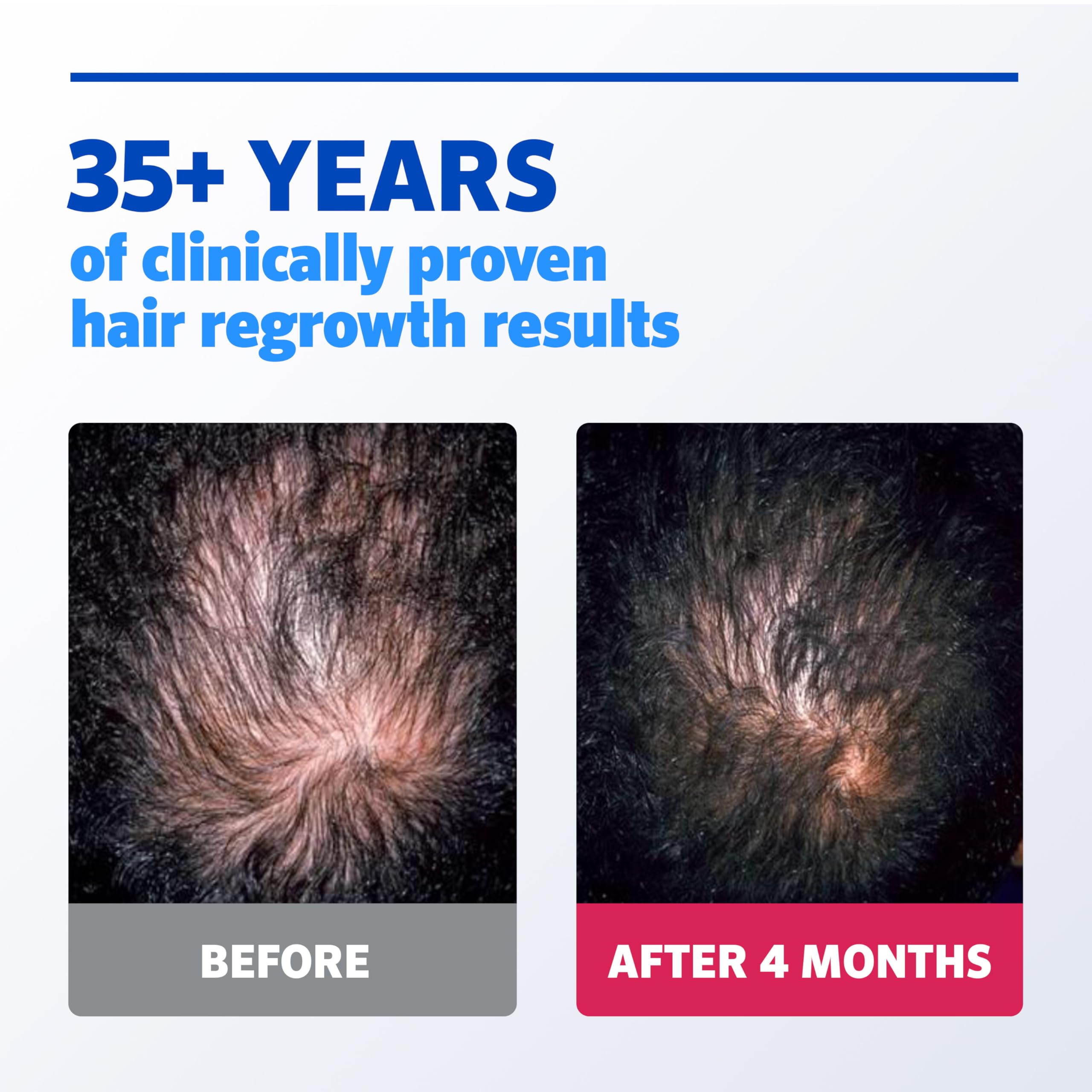 Men’s Rogaine Extra Strength 5% Minoxidil, Topical Solution for Thinning & Hair Loss, Clinically Proven FDA Approved Minoxidil for Men Treatment, Regrow Fuller Hair, 3 Month Supply, 3 Bottles