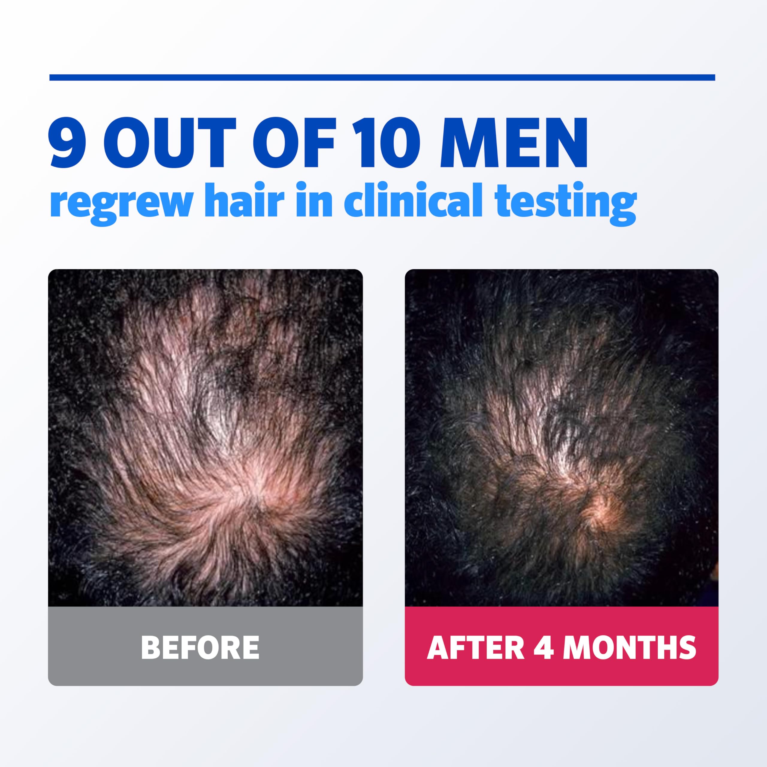 Men's Rogaine 5% Minoxidil Foam for Hair Regrowth, Topical Hair Loss Treatment for Men to Regrow Fuller, Thicker Hair, Unscented Minoxidil Topical Aerosol, 4-Month Supply, 4 x 2.11 oz